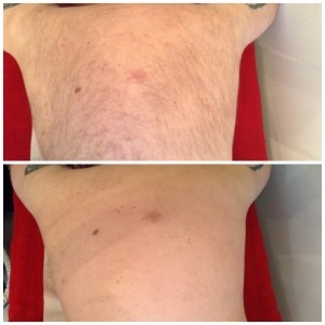 Dew Aesthetics, Chester | Laser Liposculpture | IPL Laser Hair Removal - before/after