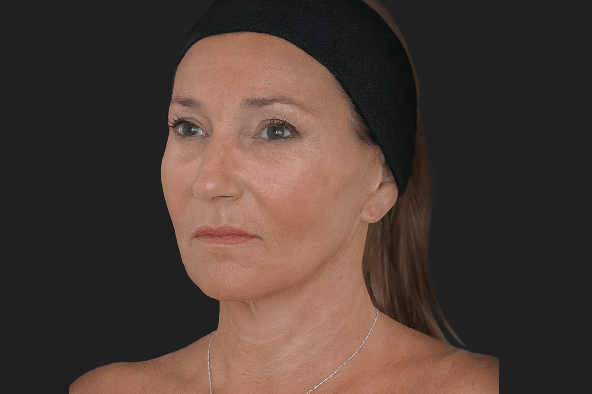 Dew Aesthetics, Chester | IPL Laser Hair Removal | Client after Ellanse treatment