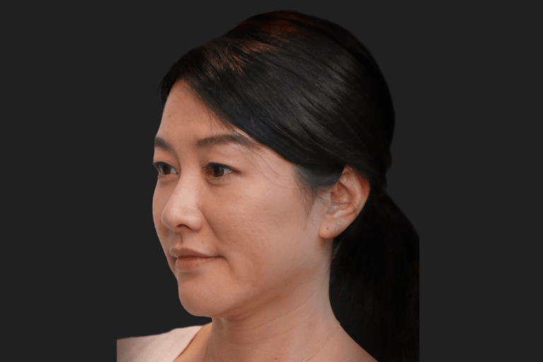 Dew Aesthetics, Chester | IPL Laser Hair Removal | Client after Ellanse treatment