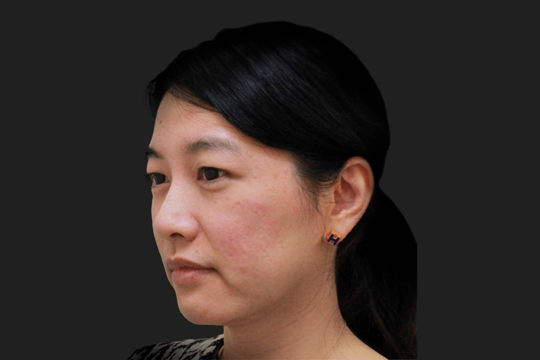 Dew Aesthetics, Chester | IPL Laser Hair Removal | Client before Ellanse treatment