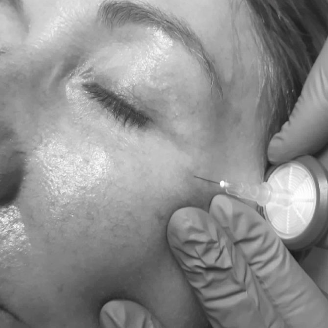Dew Aesthetics, Chester | Carboxytherapy facial treatment