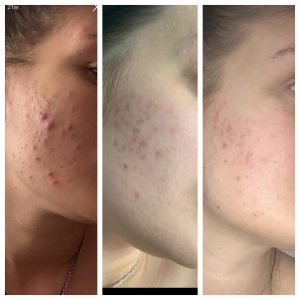 Microneedling