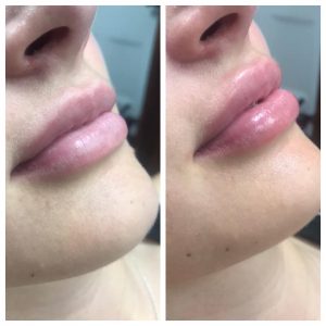 Lip Filler